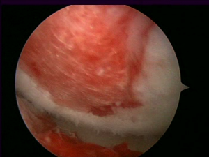 Chondrotissue Grafts